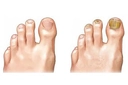 Ayak Baş Parmak Mantarı Belirtileri ve Tedavisi