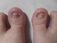 Bebeklerde Ayak Tırnak Mantarı Belirtileri ve Tedavisi