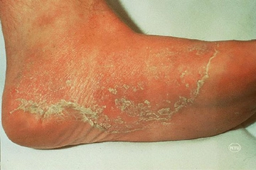 Ayak Mantarı Kaşıntı Belirtileri ve Tedavisi