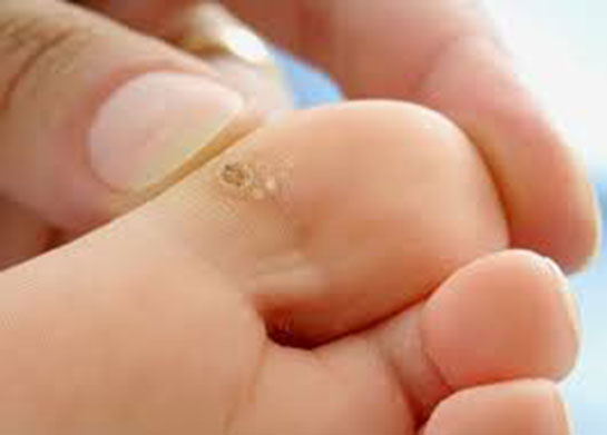 Ayak Mantarı Akıntısı Belirtileri ve Tedavisi